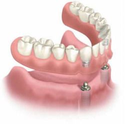 Implant Maintenance, Care and Expectations,
