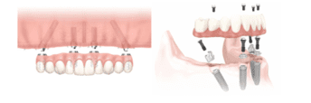 Improve your Quality of Life with a Dental Implant Supported Denture, 