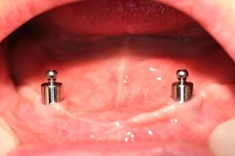 Pros and Cons of Full Dentures vs. Denture Implants,