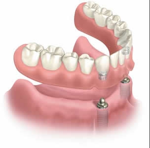 Implant Supported Denture