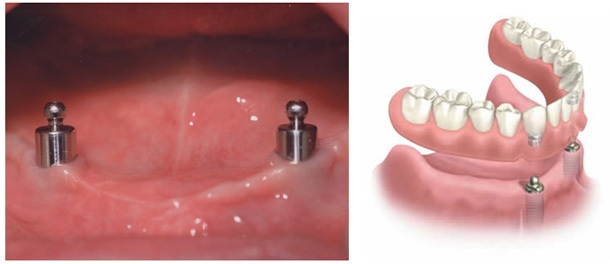 Denture dental