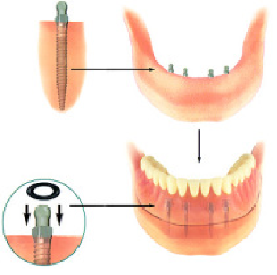 Four Implants